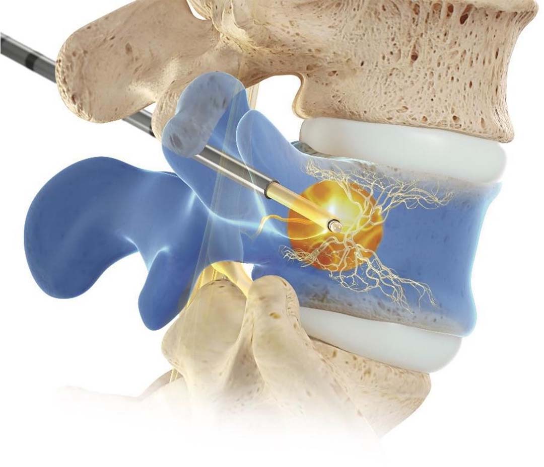 AxisSpine_Intracept_hero_mobile AxisSpine_Intracept_hero_mobile